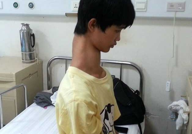 Врачи согласились отрезать шею мальчику-жирафу (Фото)