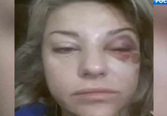 Избитая жена Башарова начала слепнуть (Фото-Видео)