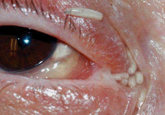 У женщины из глаза и носа достали 120 личинок (Фото)