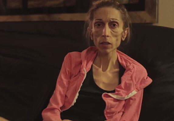 Страдающая анорексией актриса поблагодарила интернет-юзеров за поддержку (Фото-Видео)