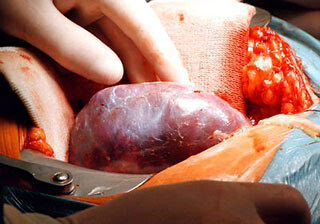 В Азербайджане будут созданы клиники для трансплантации органов