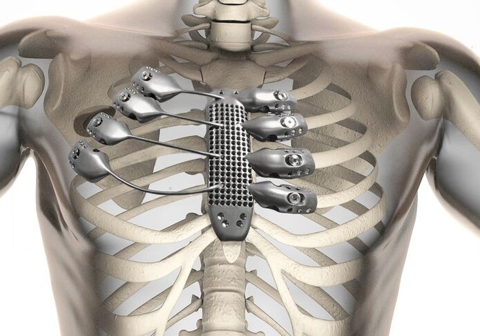 Впервые в мире пациенту пересадили ребра, напечатанные на 3D-принтере (Видео)