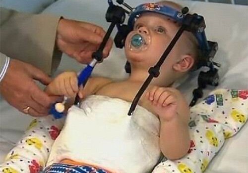 Ребенку пришили оторванную в ДТП голову (Фото-Видео)
