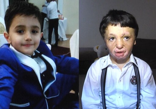 6-летний Реван Ашуров: «Я обязан Лейле Алиевой своей жизнью…» (Фото-Видео)