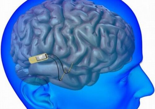Ученые: Имплантаты помогут в лечении проблем мозгa