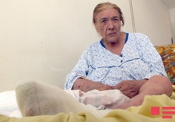 В Баку умерла женщина, которой хирург по ошибке отрезал здоровую ногу