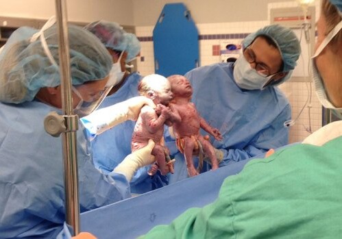 Родившиеся практически за руки близняшки спустя 2 года стали неразлучны (Фото)