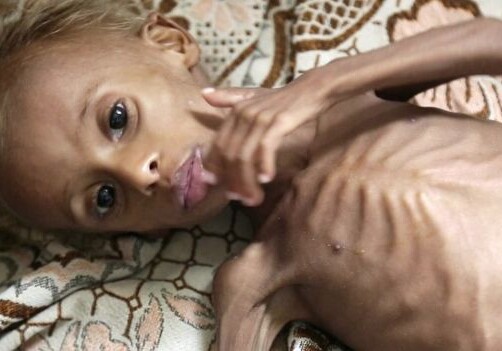 Полтора года войны в Йемене: поколение детей на грани вымирания (Фото) 