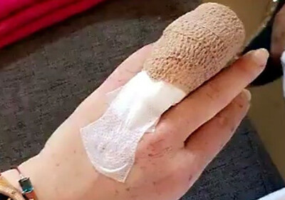 Линдси Лохан оторвало часть пальца во время отдыха в Турции