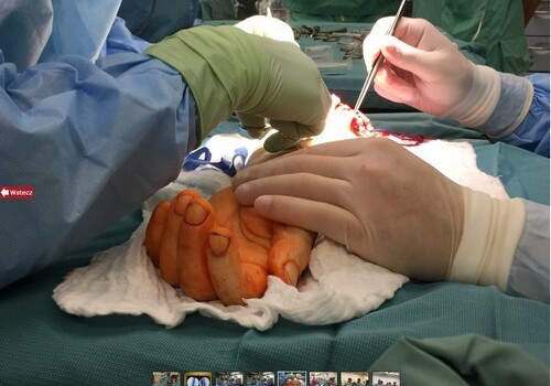 Польские хирурги впервые в мире пересадили кисть рожденному без рук человеку