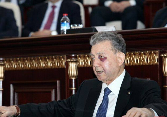 Что случилось с глазами президента НАНА? (Фото)