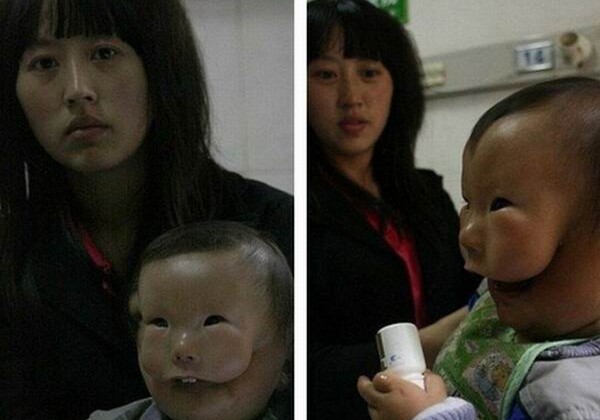 Мальчик-маска: история ребенка, родившегося с редким дефектом лица (Фото-Видео) 