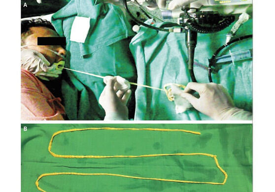 Индийские врачи извлекли двухметрового червя из кишечника пациента