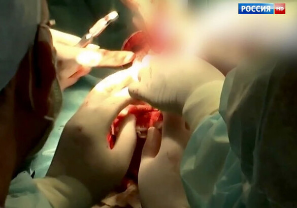 Китайские хирурги успешно разделили 3-месячных сиамских близнецов
