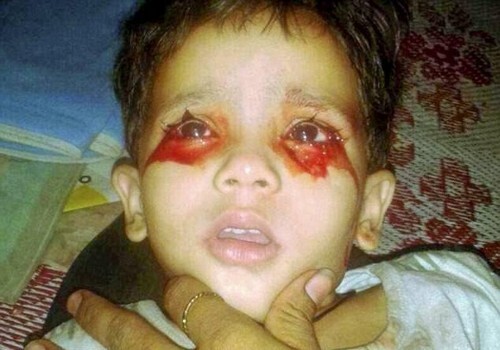 В Индии врачи не могут поставить диагноз 3-летней девочке, которая плачет кровью