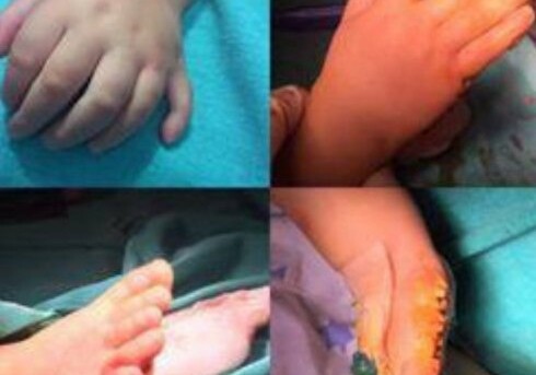 В Азербайджане прооперировали младенца с 24 пальцами (Видео)