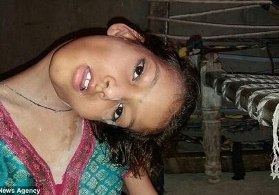 Девочка в Индии уже 9 лет живет со сломанной шеей (Фото-Видео)
