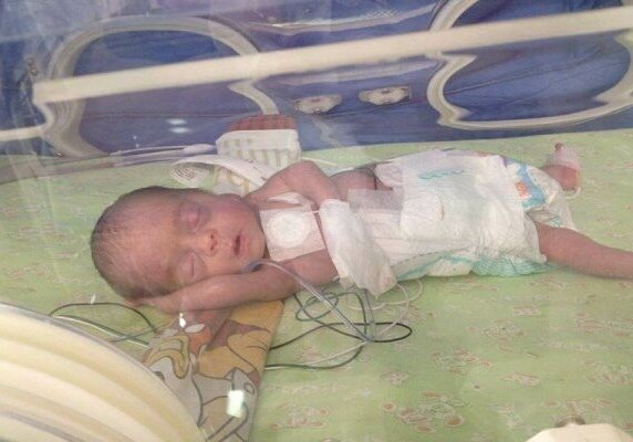 В Азербайджане прооперировали 1,3-килограммового ребенка