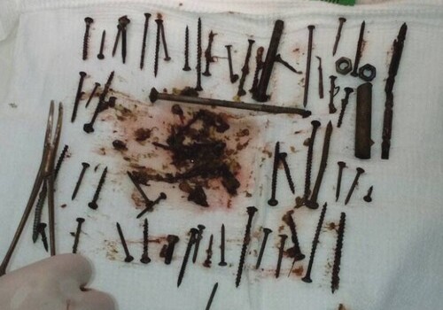 В желудке бурятской пенсионерки нашли более 150 гвоздей и отрезков арматуры
