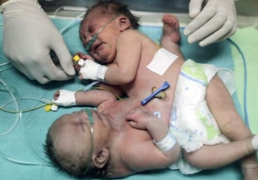 В Саудовской Аравии медики разделили сиамских близнецов (Фото)