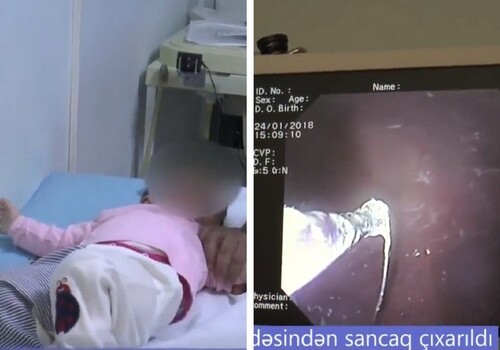 Азербайджанские врачи извлекли из желудка младенца булавку (Видео)