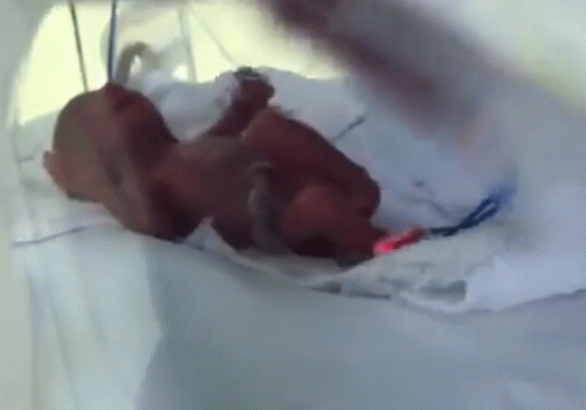 Лишенный шанса на жизнь: родители не захотели, чтобы их недоношенный 370-граммовый младенец выжил (Видео) 