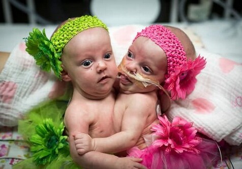 В США 75 врачей за 7 часов разделили сердца сиамских близнецов (Фото)