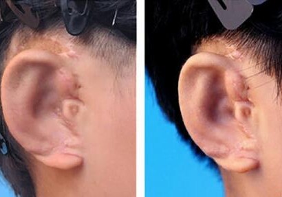 В Китае выращивают на заказ уши для детей