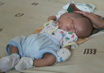 Ребенок с двумя лицами родился в Индонезии