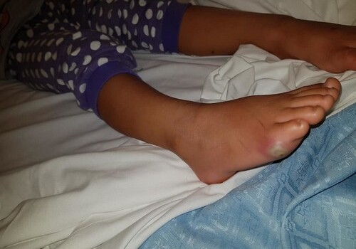 В Англии 4-летняя девочка получила заражение крови, примерив туфли в магазине