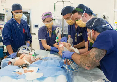 Австралийские хирурги успешно разделили сиамских близнецов