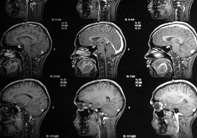 Раскрыты игнорируемые больными симптомы рака мозга