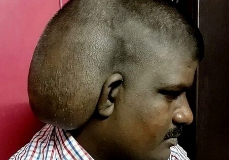 В Индии мужчине удалили на голове огромную опухоль весом в 5 кг
