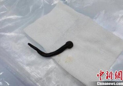 В Китае врач обнаружил в горле пациентки живую пиявку