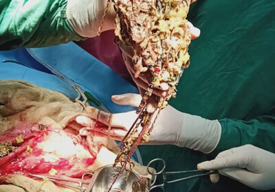 Хирург нашел в желудке пациентки драгоценный клад