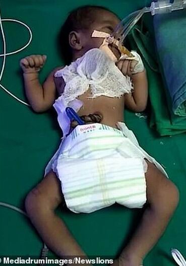 В Индии родился ребенок с сердцем наружу (Фото-Видео не для слабонервных)