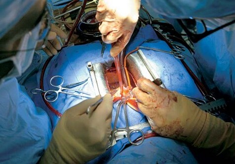 В Австрии провели операцию по пересадке мертвого сердца живому пациенту