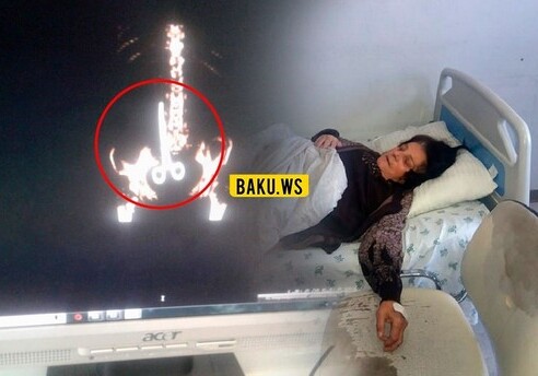 Хирурги гянджинской больницы забыли в теле пациентки ножницы (Фото)