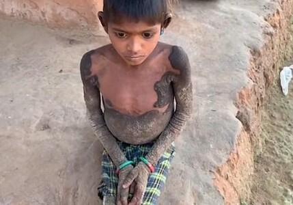 В Индии девочка «окаменела» из-за редкой болезни (Фото)