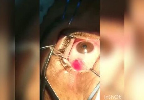 В Азербайджане из глаза пациентки извлекли червя (Видео)