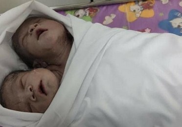 В Мьянме родились сиамские близнецы с общим телом и двумя головами