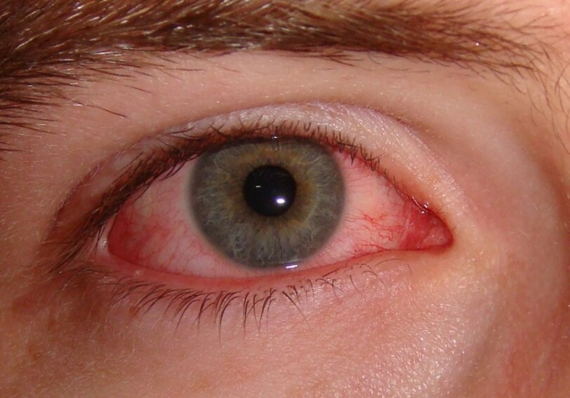 Офтальмолог: «В результате инфицирования могут возникнуть различные заболевания глаз»