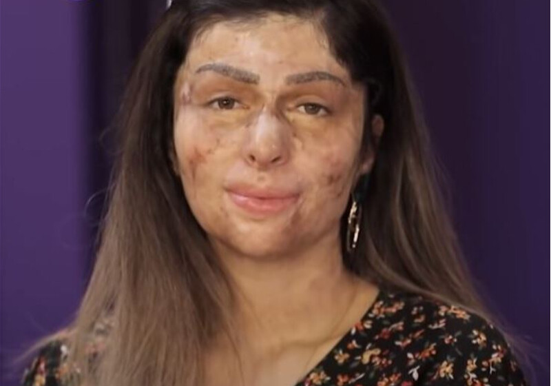 История азербайджанки с обожжённым лицом: «Провела месяц в коме, сделала около 20 операций…» (Фото-Видео)
