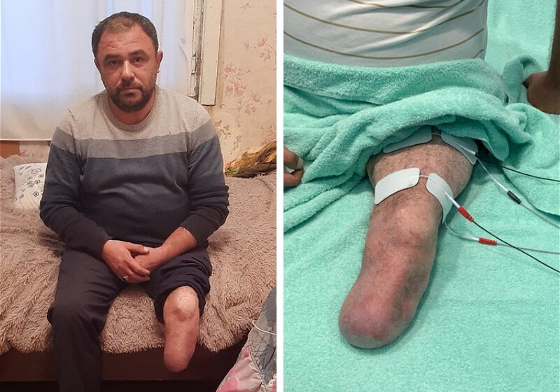 Мир не без добрых людей! Самира Гасымова, потерявшего ногу в боях, лечат на безвозмездной основе (Фото)