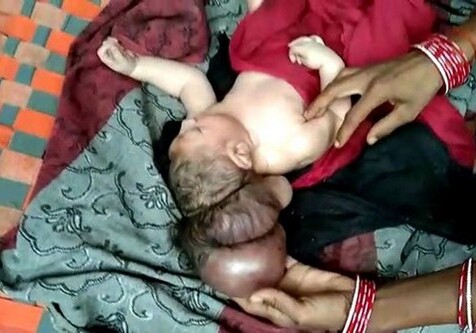 Трехголовый младенец родился в Индии  