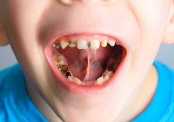 Молочные зубы оказались индикатором риска психических расстройств