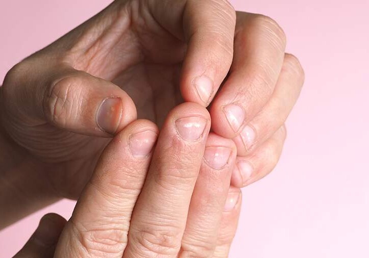 Дерматолог назвала неочевидные причины белых пятен на ногтях